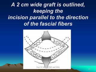 A 2 cm wide graft is outlined,
keeping the
incision parallel to the direction
of the fascial fibers
Dept Of Urology, KMC and GRH,
Chennai 55
 