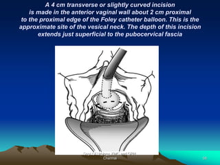 A 4 cm transverse or slightly curved incision
is made in the anterior vaginal wall about 2 cm proximal
to the proximal edge of the Foley catheter balloon. This is the
approximate site of the vesical neck. The depth of this incision
extends just superficial to the pubocervical fascia
Dept Of Urology, KMC and GRH,
Chennai 58
 