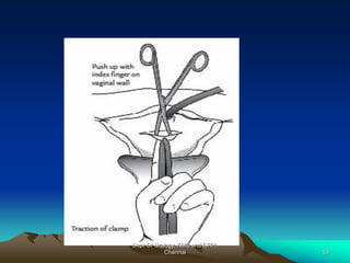 Dept Of Urology, KMC and GRH,
Chennai 59
 