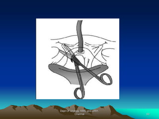 Dept Of Urology, KMC and GRH,
Chennai 60
 