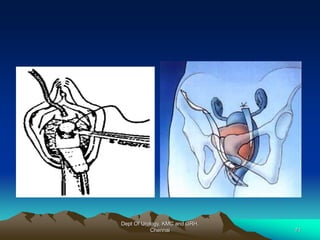 Dept Of Urology, KMC and GRH,
Chennai 71
 