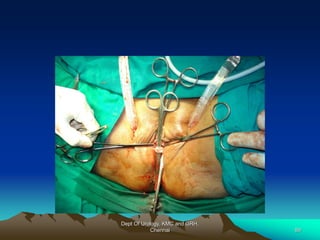 Dept Of Urology, KMC and GRH,
Chennai 89
 