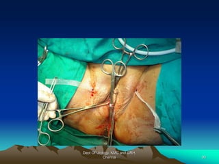 Dept Of Urology, KMC and GRH,
Chennai 90
 