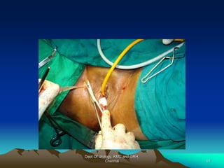 Dept Of Urology, KMC and GRH,
Chennai 91
 