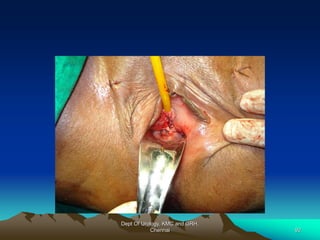 Dept Of Urology, KMC and GRH,
Chennai 92
 