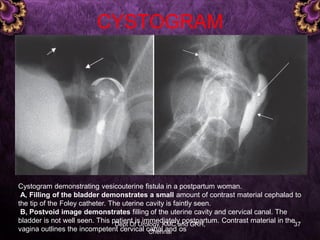 Foley Cystogram Uro gynacology- vef | PDF
