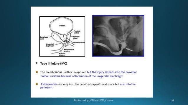 Urethrogram Process ANTEGRADE URETHROGRAM | PDF