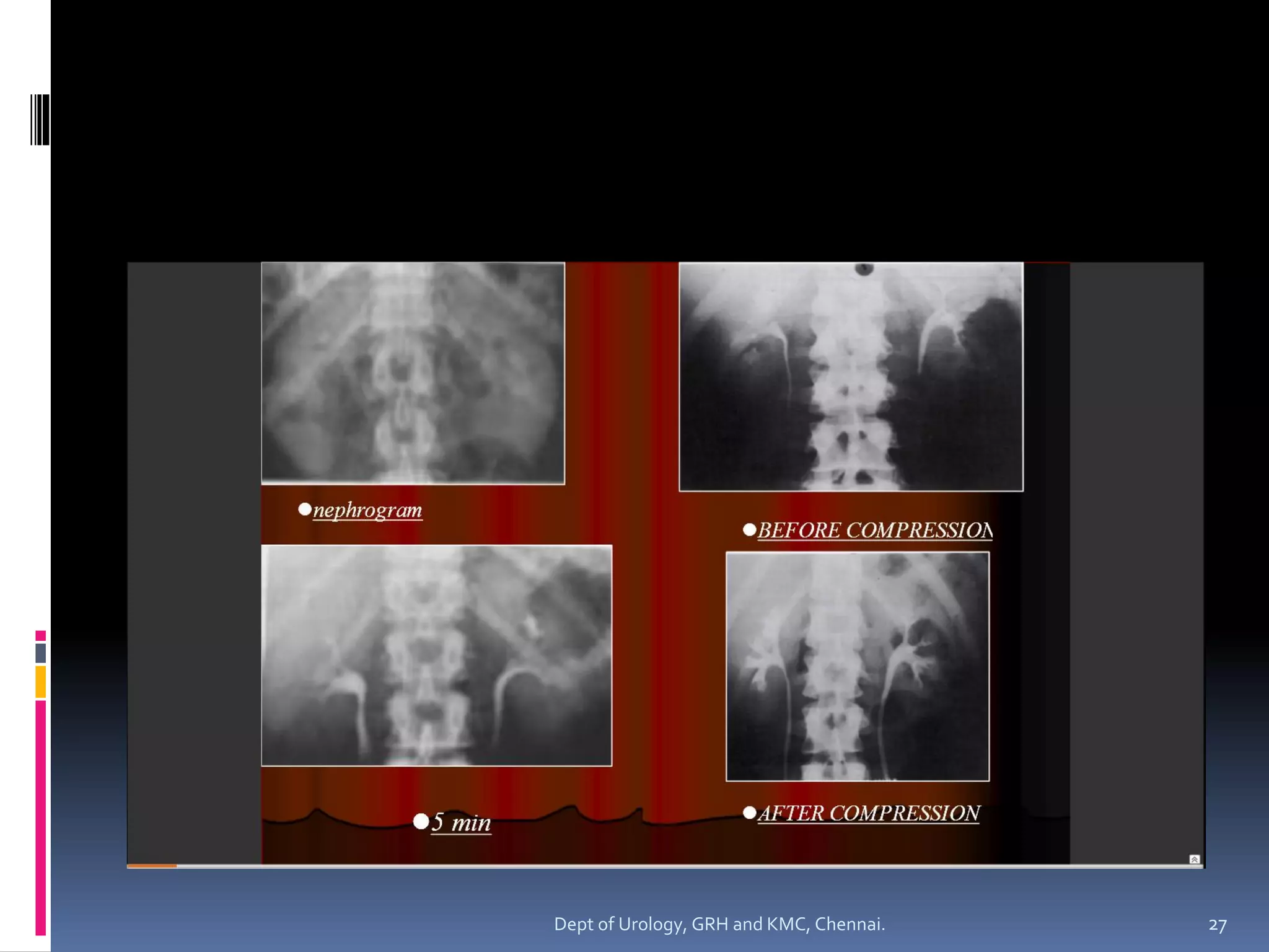 Urography Examples INTRAVENOUS UROGRAPHY 1 | PDF