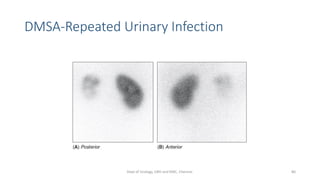 DMSA-Repeated Urinary Infection
80
Dept of Urology, GRH and KMC, Chennai.
 