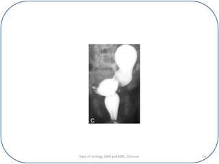 Urethrogram Cyst VOIDING CYSTO URETHROGRAM | PDF