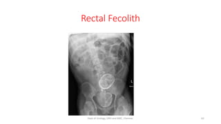 Rectal Fecolith
62
Dept of Urology, GRH and KMC, Chennai.
 