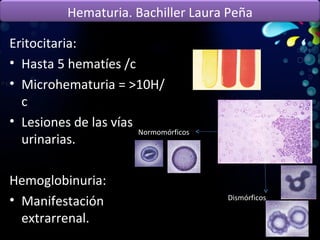 Eritocitaria: Hasta 5 hematíes /c Microhematuria = >10H/c Lesiones de las vías urinarias. Hemoglobinuria: Manifestación extrarrenal. Dismórficos Normomórficos Hematuria. Bachiller Laura Peña 