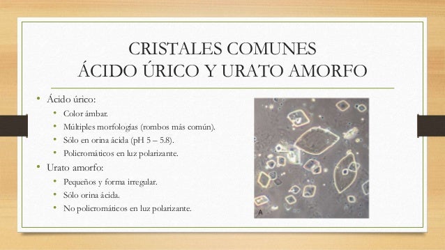 ph de orina con cristales de acido urico