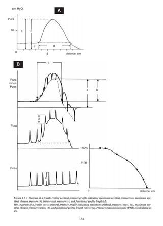 cm H2O

A

Pura

50

a

b

d

c
0

5

distance cm

c

B

Pura
minus
Pves
a

b

d

Pura

100%

PTR
Pves
e

0

distance cm

Figure 6 A : Diagram of a female resting urethral pressure profile indicating maximum urethral pressure (a), maximum urethral closure pressure (b), intravesical pressure (c), and functional profile length (d).
6B: Diagram of a female stress urethral pressure profile indicating maximum urethral pressure (stress) (a), maximum urethral closure pressure (stress) (b), and functional profile length (stress) (c). Pressure transmission ratio (PTR) is calculated as
d/e.

334

 