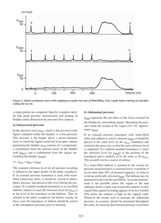 cm H2O
Pves
50

Pabd
50

a

b

a

b

Pdet
50

0
0

100

200

300

Volume (ml)

Figure 2 : IIdeal cystometric traces with coughing at regular intervals of 50ml filling. Note coughs before starting (a) and after
ending the test (b).

b) Abdominal pressure

a single patient are compared. Specific examples include leak point pressure measurement and grading of
bladder outlet obstruction by pressure-flow analysis.

pabd represents the net effect of the forces exerted on
the bladder by surrounding organs. Measuring the pressure inside the rectum or the vagina [18, 19] approxi18 19
mates pabd.

a) Intravesical pressure
In the physical sense pves, which is the pressure in the
liquid contained within the bladder, is a true pressure.
This pressure is the height, above a given reference
level, to which the liquid would rise in an open catheter
puncturing the bladder. pves consists of 2 components:
a contribution from the internal forces in the bladder
wall (pdet), and a contribution from the organs surrounding the bladder (pabd):

If an external pressure transducer with water-filled
tubes and catheter is used to measure pabd, it should be
placed at the same level as the pves transducer and
zeroed in the same way, so that the same reference level
is employed. If a catheter-mounted transducer is used,
the reference level for pabdis at the position of the
transducer and is unlikely to be the same as for pves.
This in itself can be a source of artifact.

i.e., pves = pdet + pabd.

If a water-filled balloon is inserted in the rectum for
pressure measurement it is essential not to overinflate it
(to no more than 50% of nominal capacity), in order to
avoid an artificially elevated pabd. The balloon may be
punctured to prevent this possibility. Accurate measurement is not possible unless the vagina or the anal
sphincter forms a tight seal around the catheter. In this
regard intravaginal recording appears to be less reliable
[20] unless the catheter is high in the vaginal vault.
20
Whatever the means used to measure the abdominal
pressure, its accuracy should be monitored throughout
the study, by ensuring that transient pressure excursions

The standard reference level for all pressure recording
is defined as the upper border of the pubic symphysis.
If an external pressure transducer is used with waterfilled connecting tubes, it should be zeroed to atmospheric pressure and placed at this level during the procedure. If a catheter-mounted transducer or an air-filled
balloon catheter is used, the reference level for pves is
at the level of the transducer or the balloon. Thus its
relation to the pubic symphysis not known exactly. In
these cases the transducer or balloon should be zeroed
to the atmospheric pressure prior to insertion.

323

 