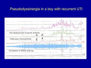 Pseudodyssinergia in a boy with recurrent UTI 