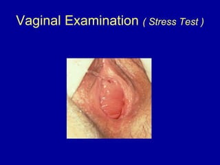 Vaginal Examination  ( Stress Test ) 