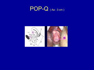 POP-Q  ( Aa : 3 cm ) 