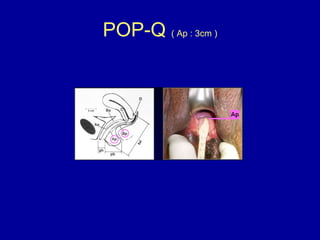 POP-Q  ( Ap : 3cm ) 