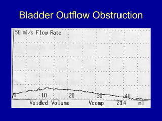 Bladder Outflow Obstruction 
