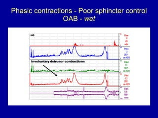 Phasic contractions - Poor sphincter control OAB -  wet 