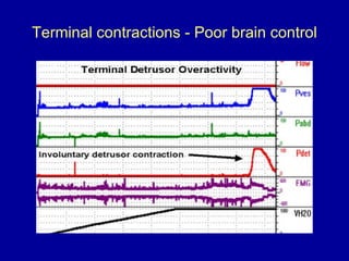 Terminal contractions - Poor brain control 