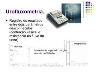 Urofluxometria. Registro do resultado entre dois parâmetros desconhecidos (contração vesical e resistência ao fluxo da urina). Normal Intermitente sugerindo micção através de Valsalva Inespecífico 