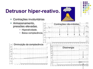 Detrusor hiper-reativo. Contrações involuntárias Armazenamento, pressões elevadas. Hiperatividade. Baixa complacência. Contrações não-inibidas Diminuição da complacência Dissinergia 