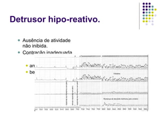 Detrusor hipo-reativo. Ausência de atividade não inibida. Contração inadequada. arreflexia. bexiga não-contrátil. 