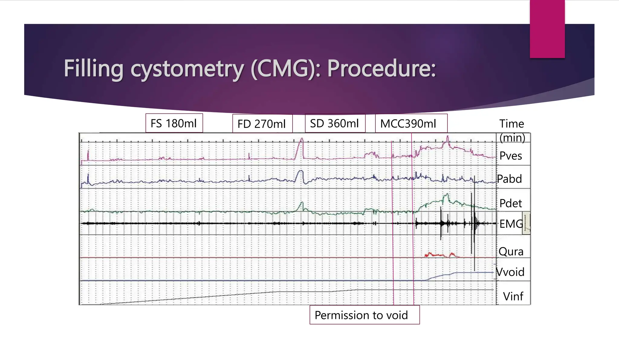Filling cystometry (CMG): Procedure:
Time
(min)
Pves
Pabd
Pdet
EMG
Qura
Vvoid
Vinf
FS 180ml FD 270ml SD 360ml MCC390ml
Permission to void
 