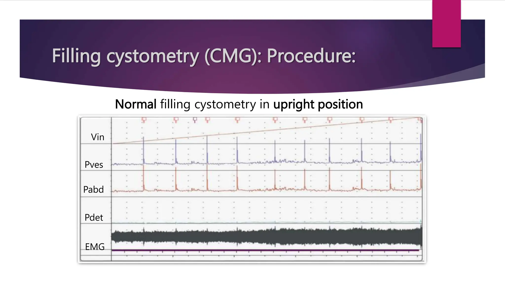 Filling cystometry (CMG): Procedure:
Normal filling cystometry in upright position
Vin
Pabd
Pves
Pdet
EMG
 