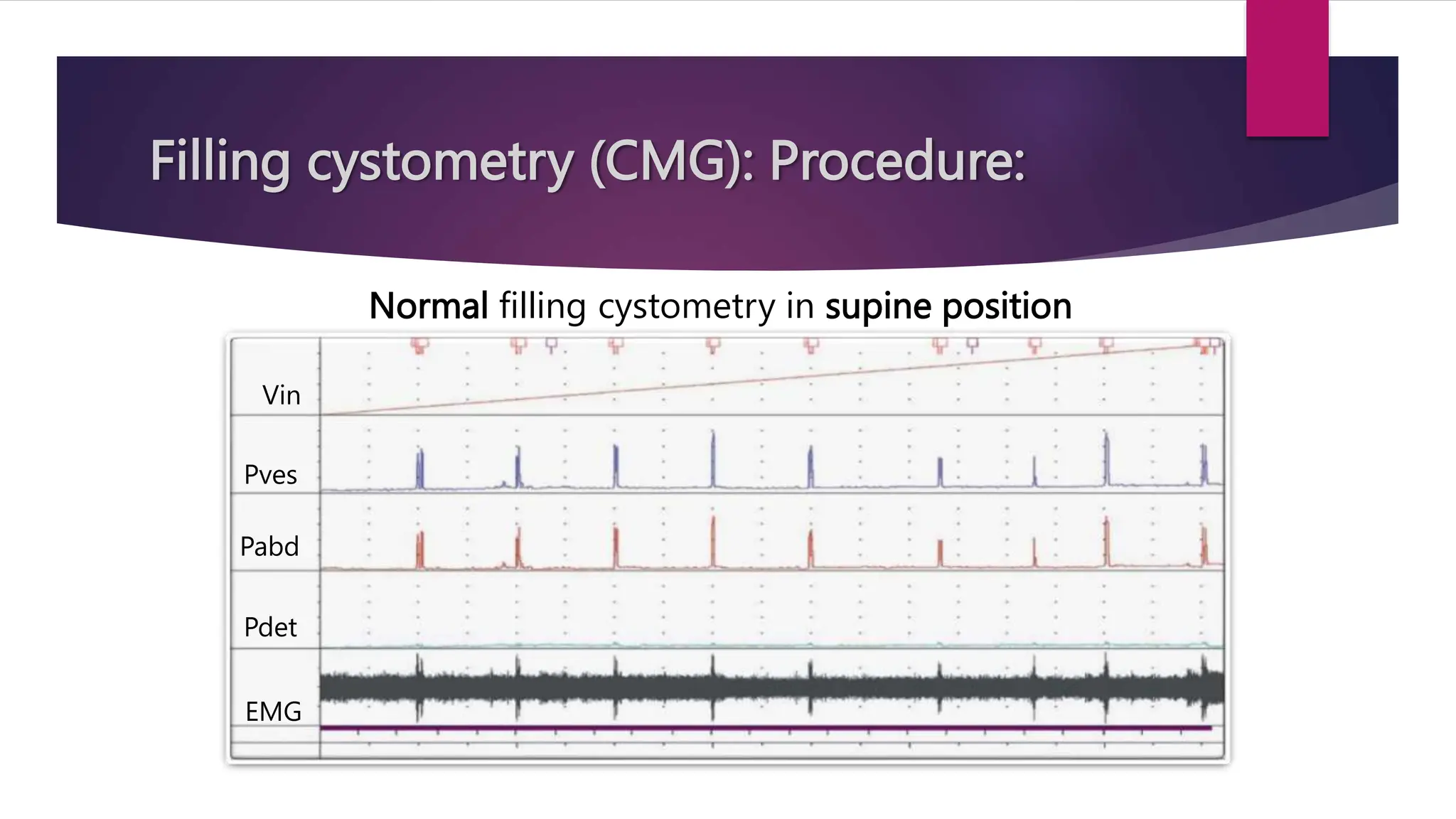 Filling cystometry (CMG): Procedure:
Normal filling cystometry in supine position
Vin
Pabd
Pves
Pdet
EMG
 