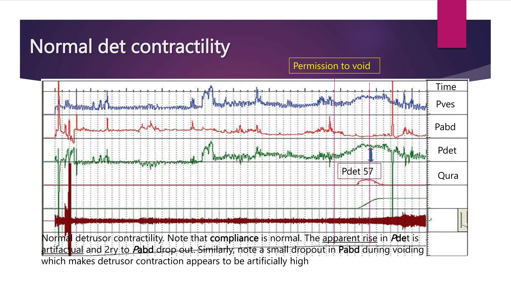 Normal det contractility
Normal detrusor contractility. Note that compliance is normal. The apparent rise in Pdet is
artifactual and 2ry to Pabd drop out. Similarly, note a small dropout in Pabd during voiding
which makes detrusor contraction appears to be artificially high
Permission to void
Pdet 57
Time
Pves
Pabd
Pdet
Qura
 