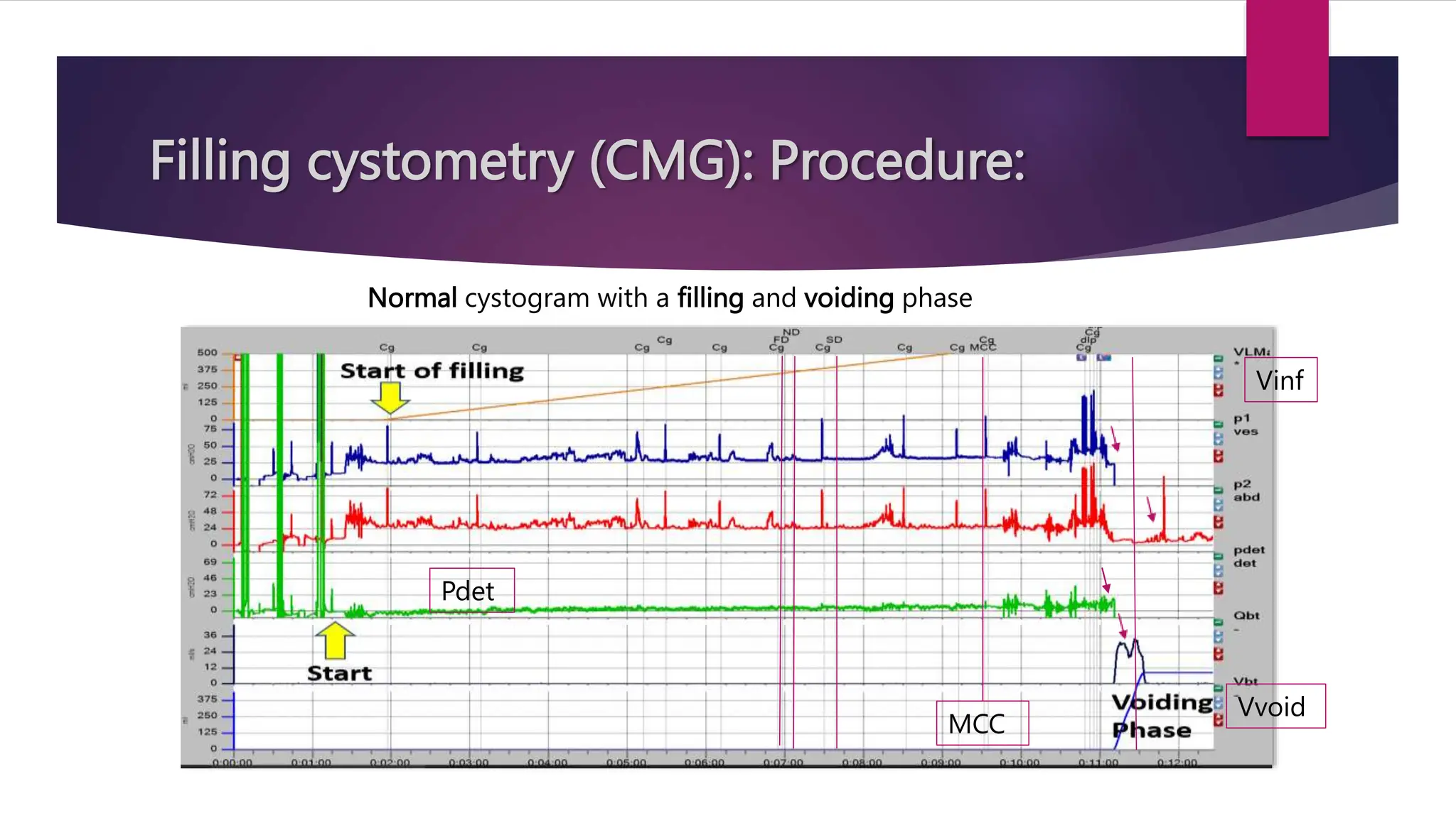 Filling cystometry (CMG): Procedure:
Normal cystogram with a filling and voiding phase
Vvoid
Vinf
MCC
Pdet
 