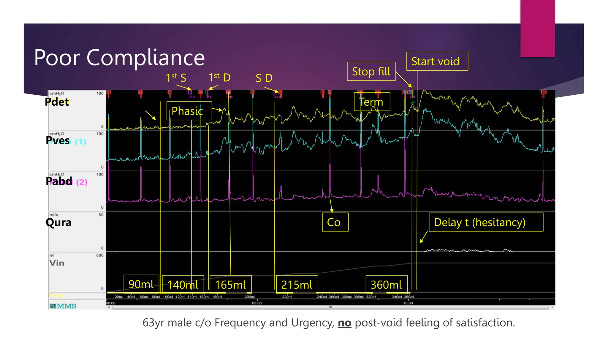 Poor Compliance
63yr male c/o Frequency and Urgency, no post-void feeling of satisfaction.
Pdet
Pves
Pabd
Qura
1st S 1st D S D
Start void
Delay t (hesitancy)
Stop fill
Phasic
Term
140ml 165ml 360ml
215ml
90ml
Co
 