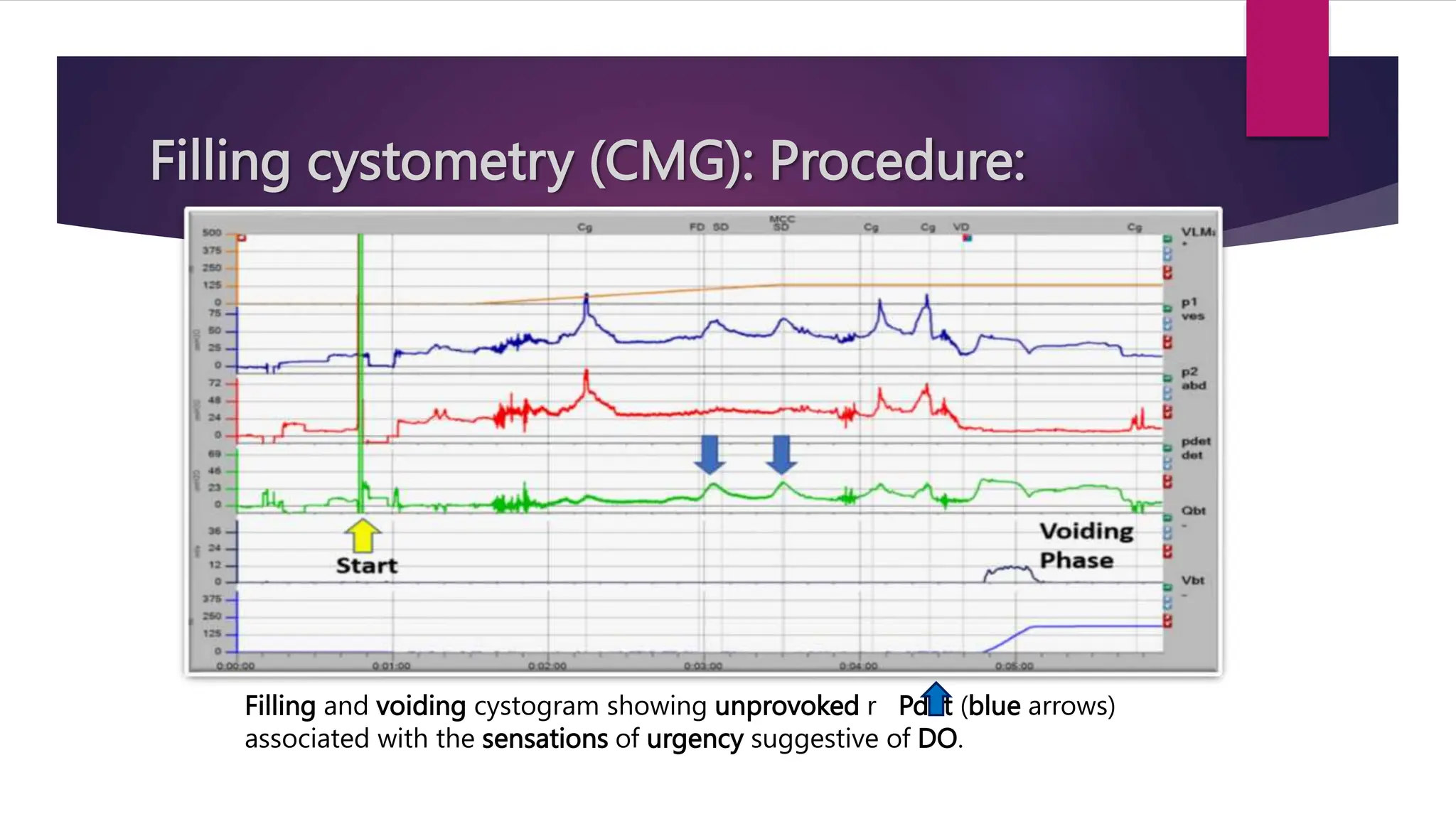 Filling cystometry (CMG): Procedure:
Filling and voiding cystogram showing unprovoked r Pdet (blue arrows)
associated with the sensations of urgency suggestive of DO.
 