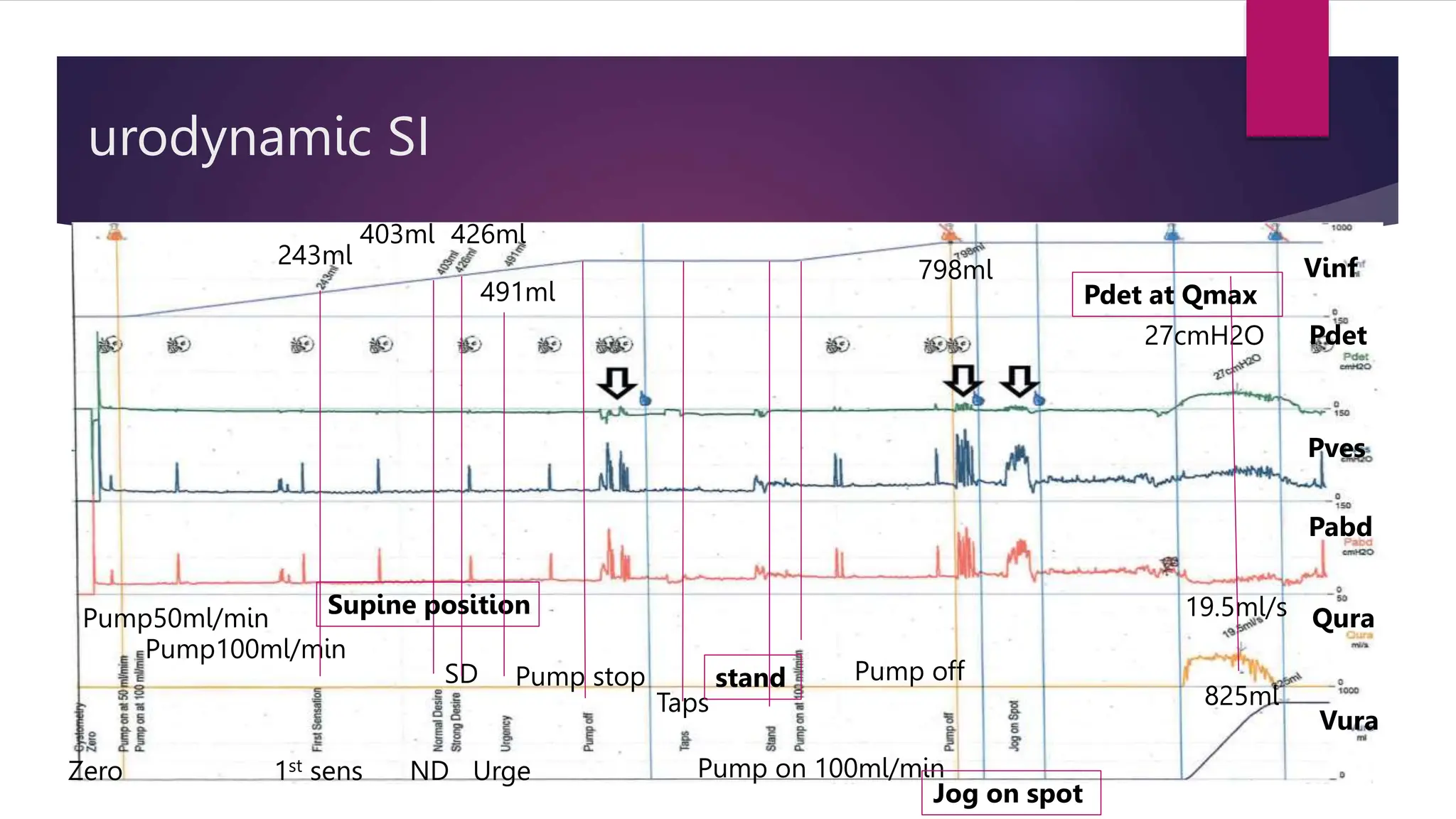urodynamic SI
Pump50ml/min
Pump100ml/min
1st sens ND
SD
Urge
Pump stop
Zero
Taps
stand
Pump on 100ml/min
Pump off
Jog on spot
Vinf
Pdet
Pves
Pabd
Qura
Vura
19.5ml/s
825ml
243ml
403ml 426ml
491ml
798ml
27cmH2O
Supine position
Pdet at Qmax
 