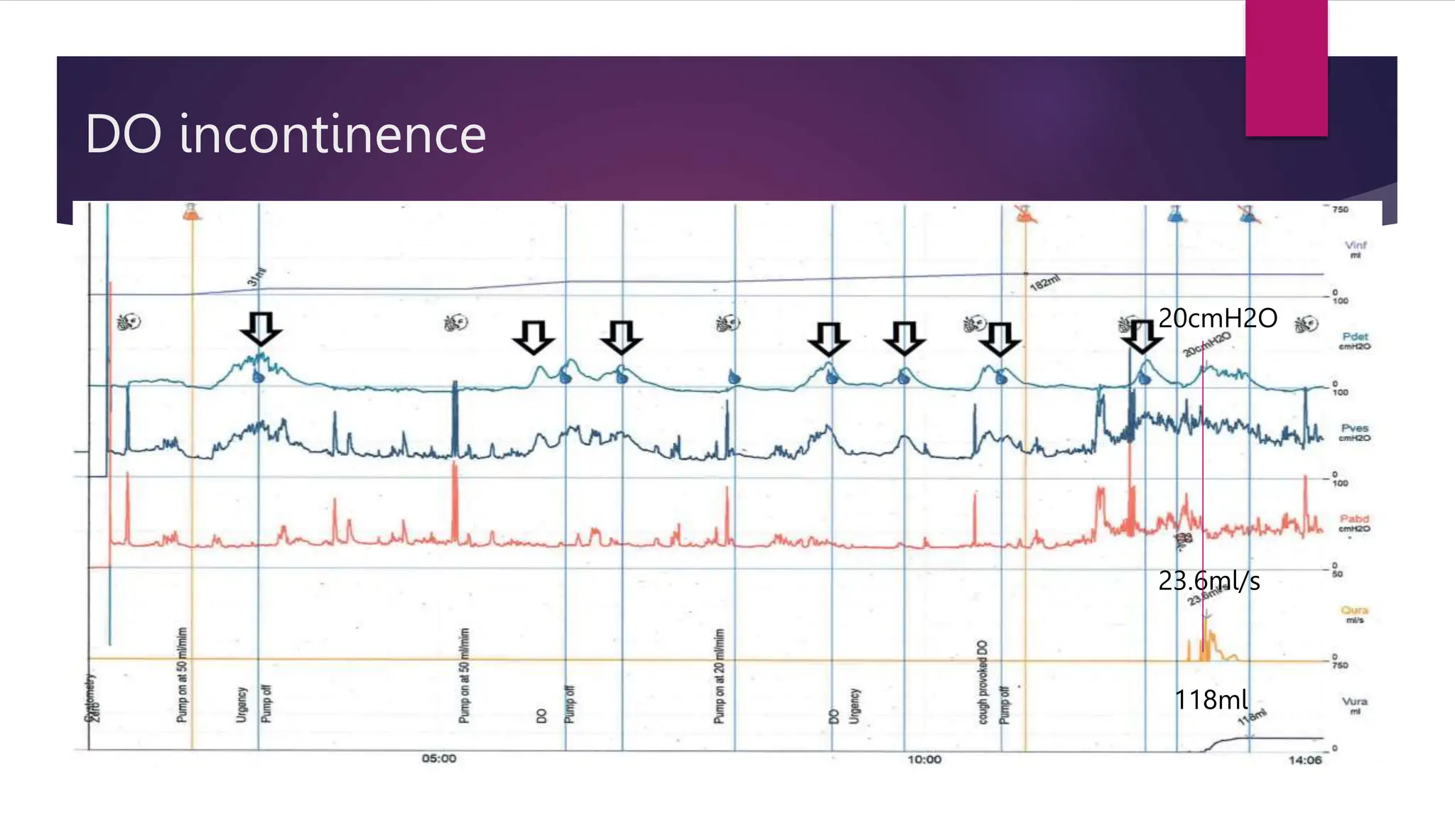 DO incontinence
118ml
23.6ml/s
20cmH2O
 
