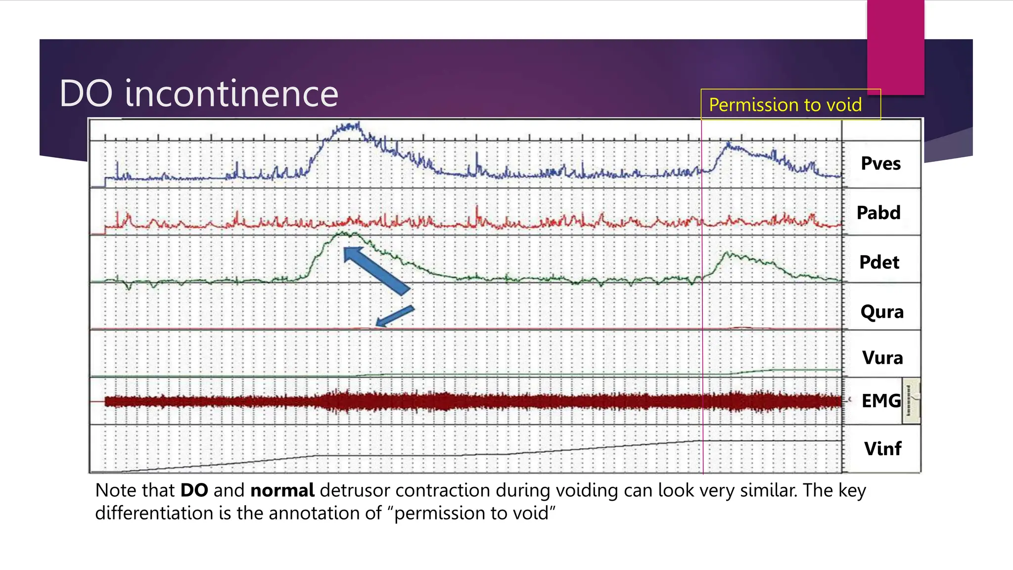 DO incontinence
Pves
Pabd
Pdet
Qura
Vura
EMG
Vinf
Permission to void
Note that DO and normal detrusor contraction during voiding can look very similar. The key
differentiation is the annotation of “permission to void”
 