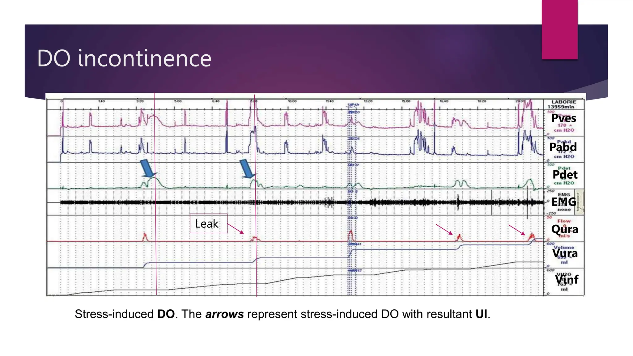 DO incontinence
Pabd
Pves
Pdet
Qura
Vura
EMG
Vinf
Stress-induced DO. The arrows represent stress-induced DO with resultant UI.
Leak
 