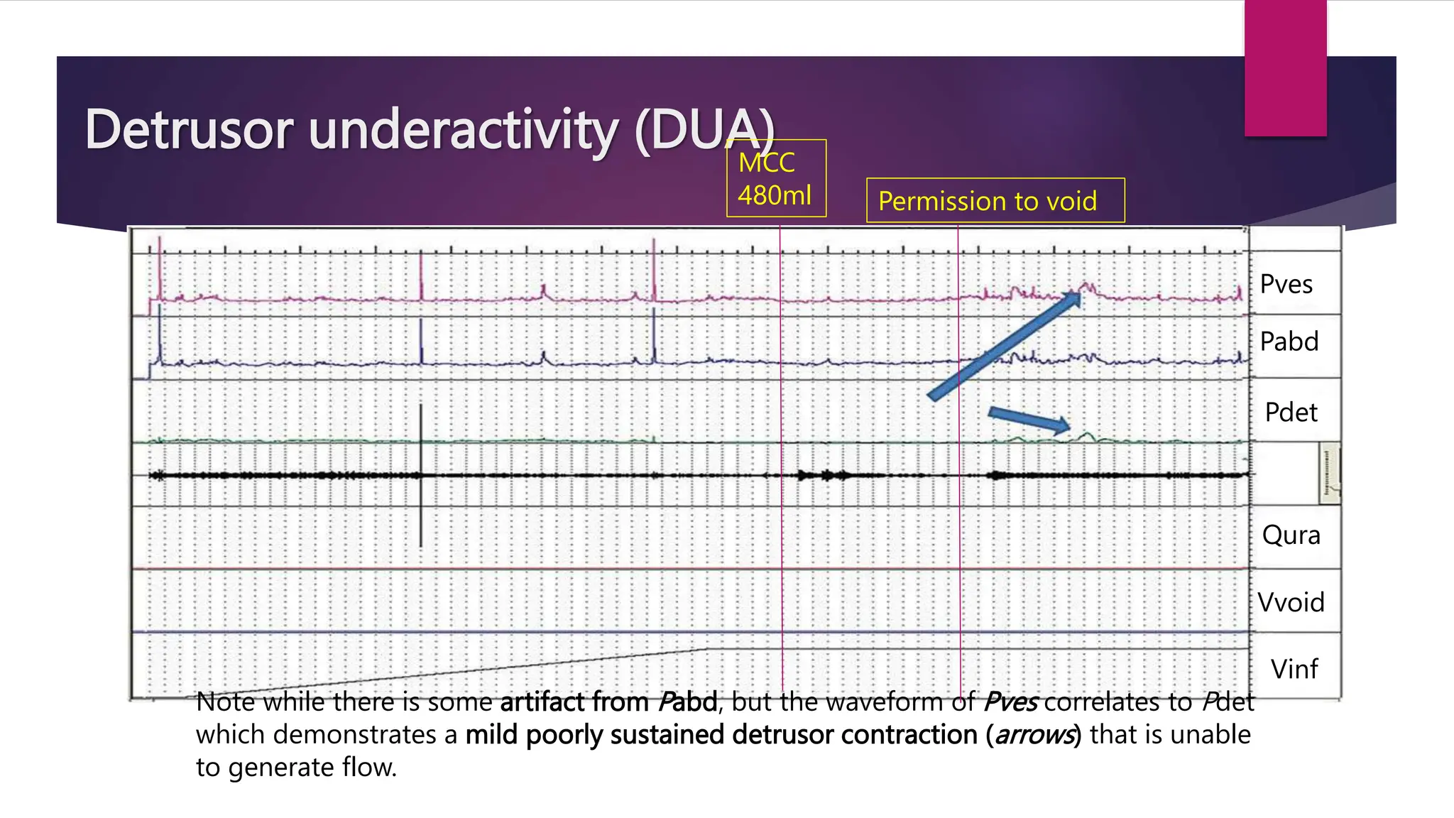 Detrusor underactivity (DUA)
Note while there is some artifact from Pabd, but the waveform of Pves correlates to Pdet
which demonstrates a mild poorly sustained detrusor contraction (arrows) that is unable
to generate flow.
Pves
Pabd
Pdet
Qura
Vvoid
Vinf
MCC
480ml Permission to void
 