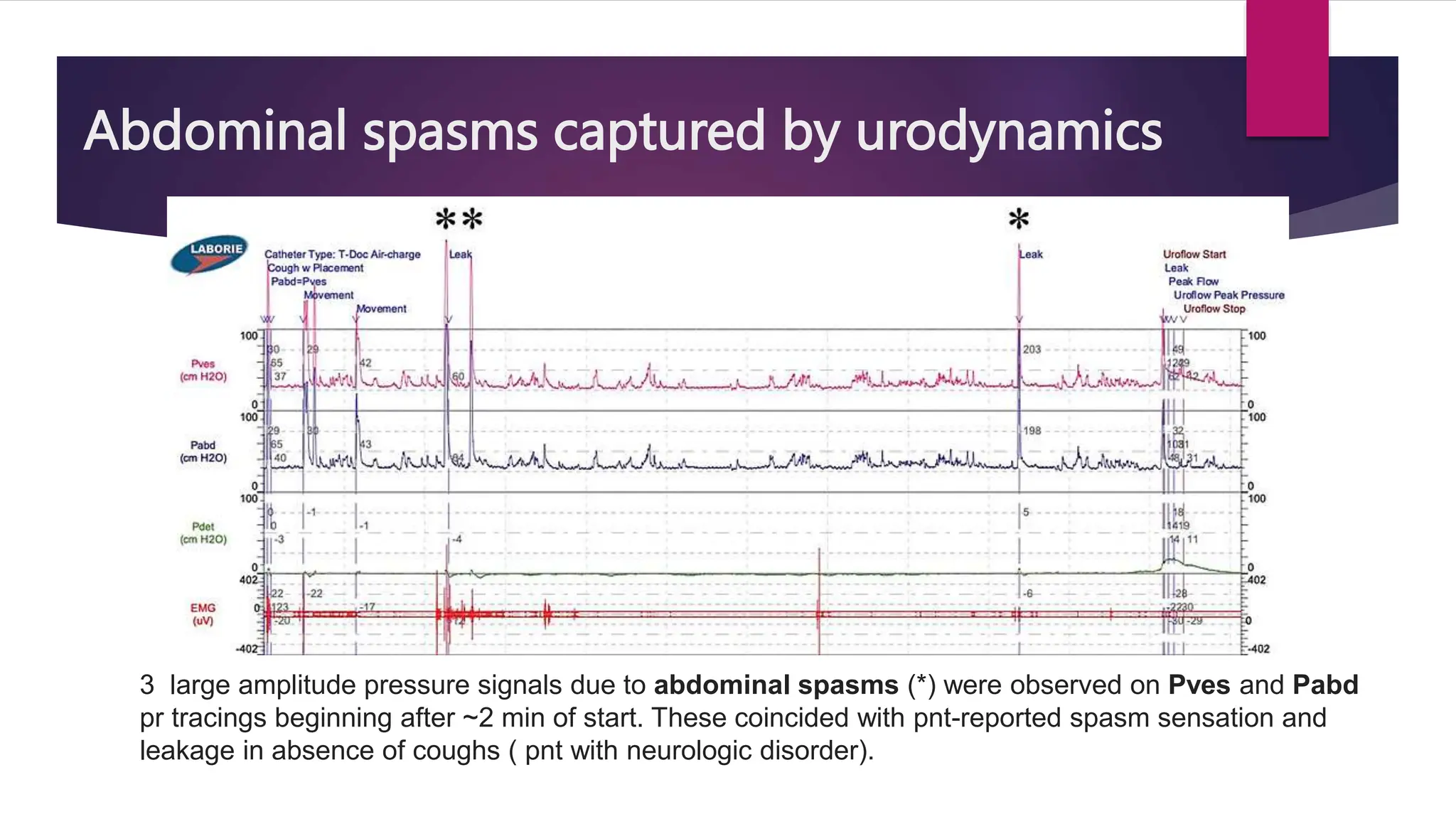 Abdominal spasms captured by urodynamics
3 large amplitude pressure signals due to abdominal spasms (*) were observed on Pves and Pabd
pr tracings beginning after ~2 min of start. These coincided with pnt-reported spasm sensation and
leakage in absence of coughs ( pnt with neurologic disorder).
 