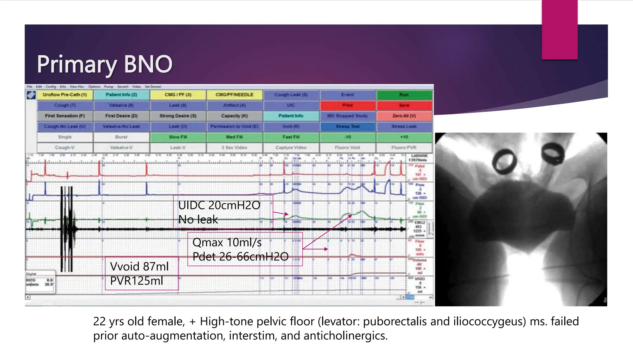 Primary BNO
22 yrs old female, + High-tone pelvic floor (levator: puborectalis and iliococcygeus) ms. failed
prior auto-augmentation, interstim, and anticholinergics.
UIDC 20cmH2O
No leak
Qmax 10ml/s
Pdet 26-66cmH2O
Vvoid 87ml
PVR125ml
 