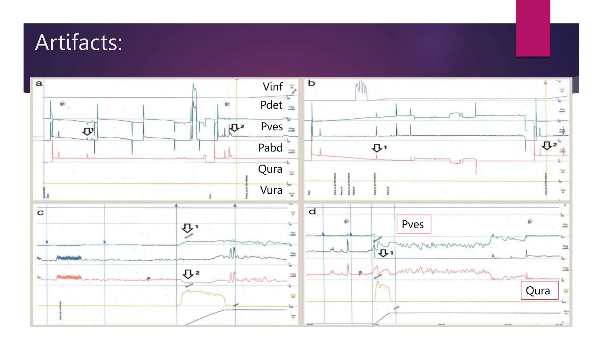 Artifacts:
Vinf
Pdet
Pves
Pabd
Qura
Vura
Qura
Pves
 