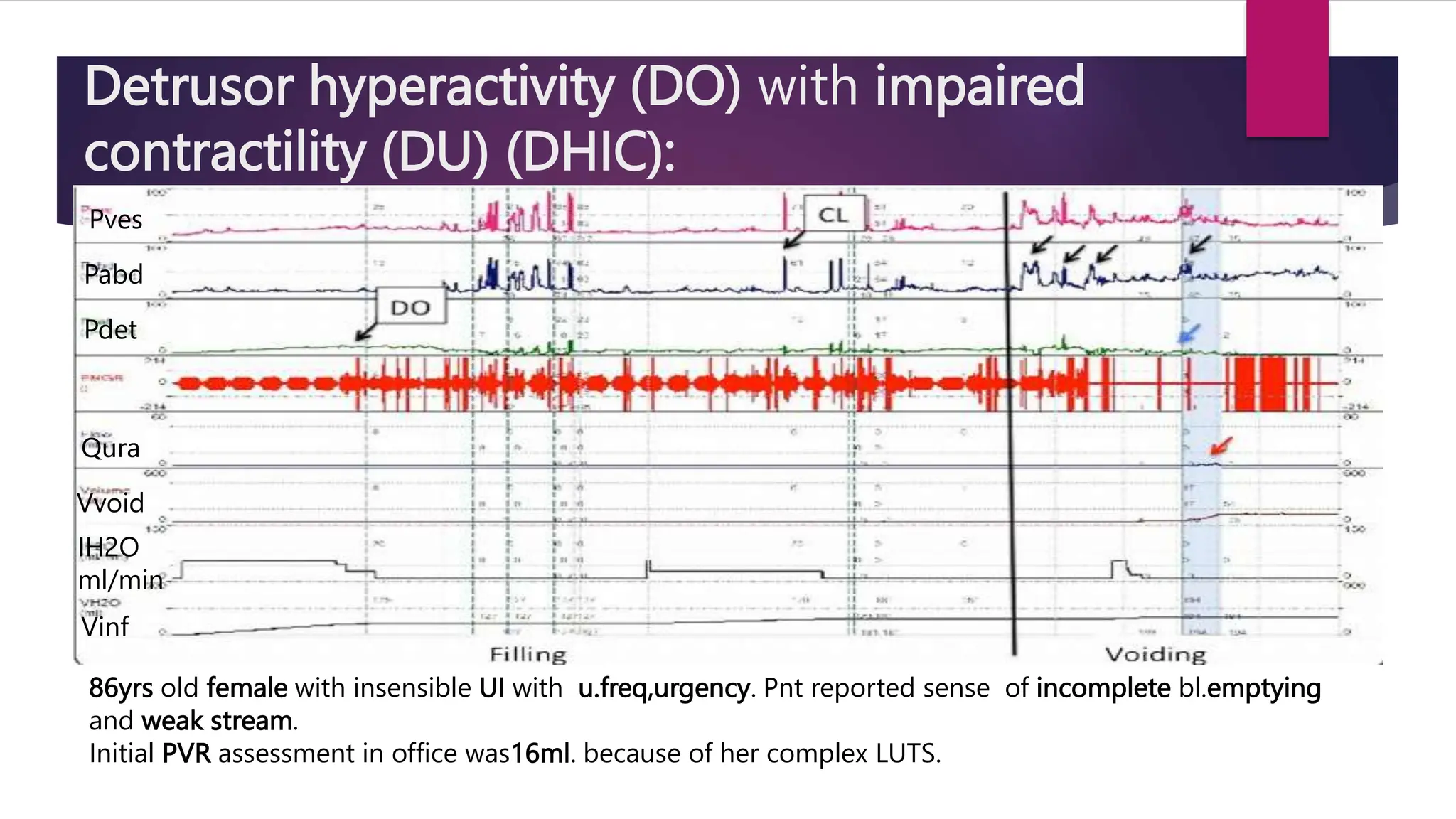 Detrusor hyperactivity (DO) with impaired
contractility (DU) (DHIC):
86yrs old female with insensible UI with u.freq,urgency. Pnt reported sense of incomplete bl.emptying
and weak stream.
Initial PVR assessment in office was16ml. because of her complex LUTS.
Pves
Pabd
Pdet
Qura
Vvoid
Vinf
IH2O
ml/min
 