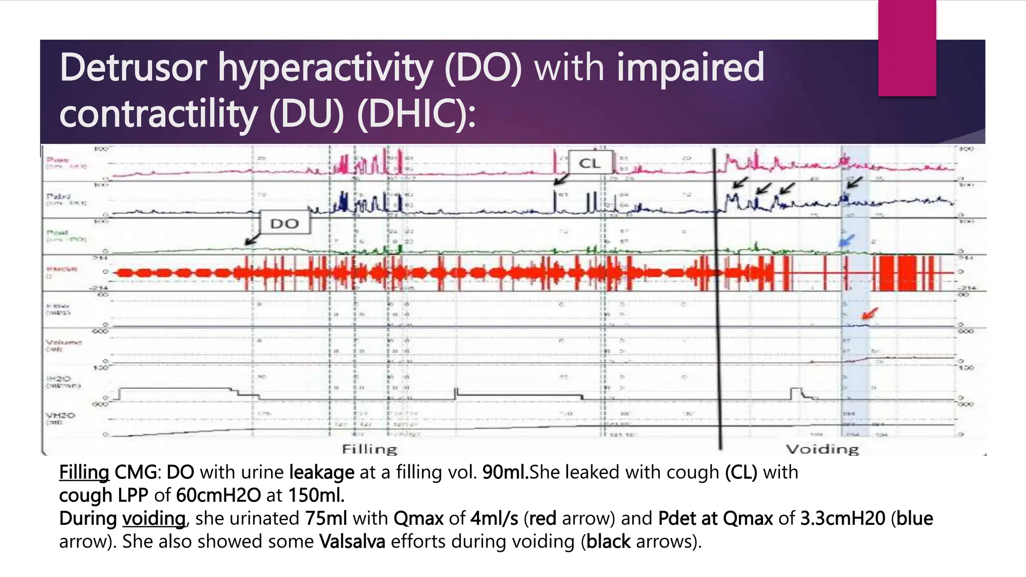 Detrusor hyperactivity (DO) with impaired
contractility (DU) (DHIC):
Filling CMG: DO with urine leakage at a filling vol. 90ml.She leaked with cough (CL) with
cough LPP of 60cmH2O at 150ml.
During voiding, she urinated 75ml with Qmax of 4ml/s (red arrow) and Pdet at Qmax of 3.3cmH20 (blue
arrow). She also showed some Valsalva efforts during voiding (black arrows).
 