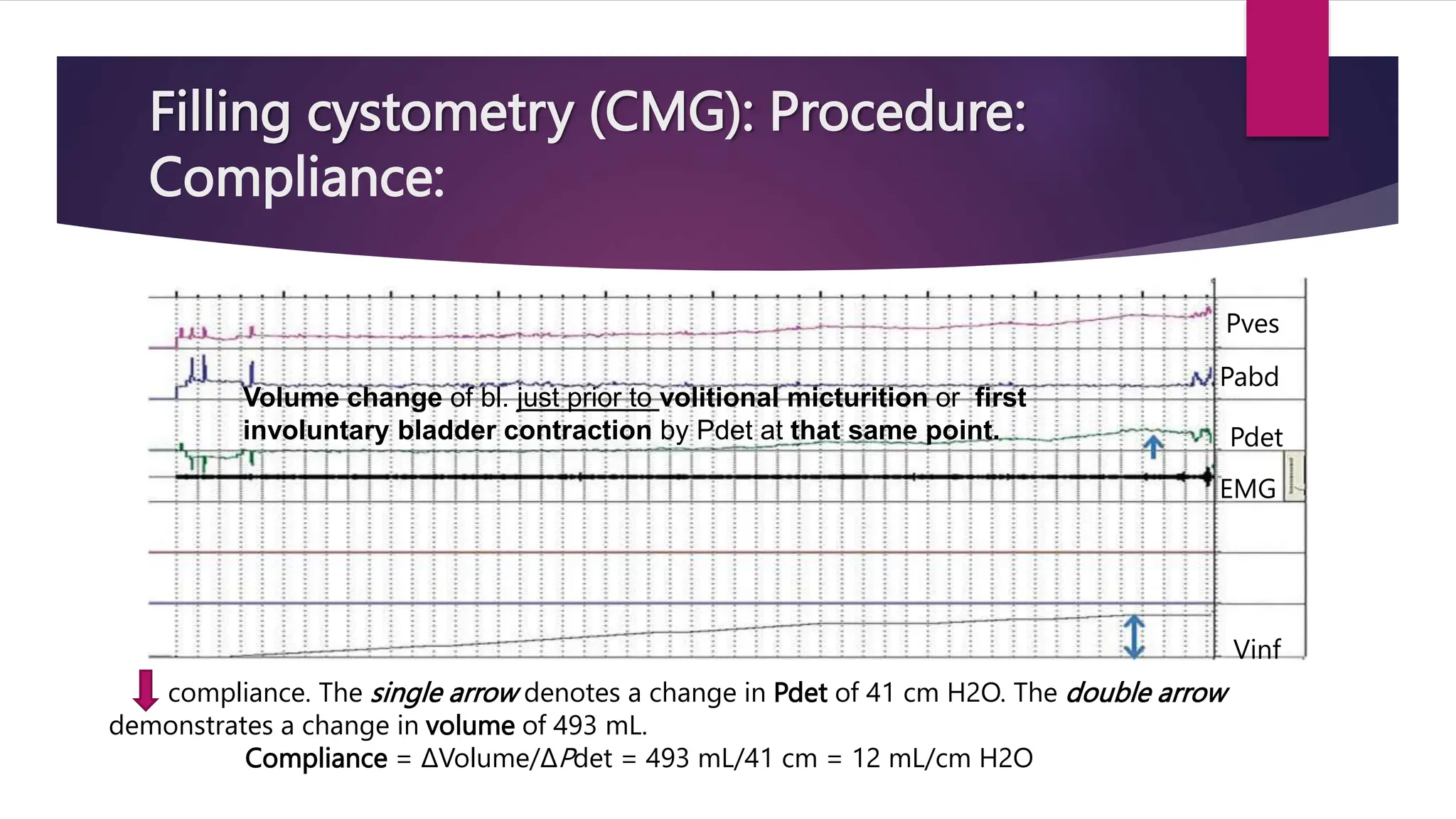 Filling cystometry (CMG): Procedure:
Compliance:
compliance. The single arrow denotes a change in Pdet of 41 cm H2O. The double arrow
demonstrates a change in volume of 493 mL.
Compliance = ΔVolume/ΔPdet = 493 mL/41 cm = 12 mL/cm H2O
Pves
Pabd
Pdet
EMG
Vinf
Volume change of bl. just prior to volitional micturition or first
involuntary bladder contraction by Pdet at that same point.
 