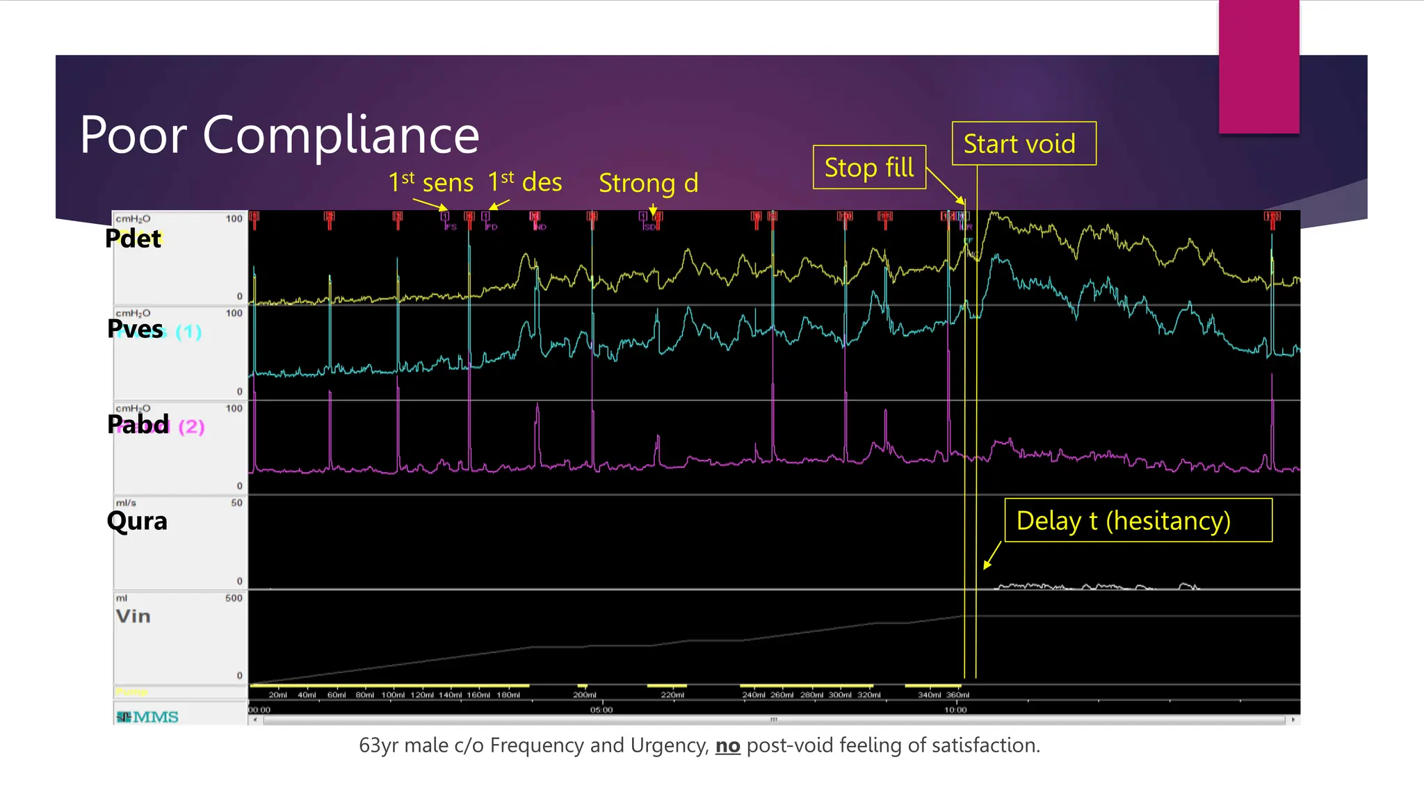 Poor Compliance
63yr male c/o Frequency and Urgency, no post-void feeling of satisfaction.
Pdet
Pves
Pabd
Qura
1st sens 1st des Strong d
Start void
Delay t (hesitancy)
Stop fill
 