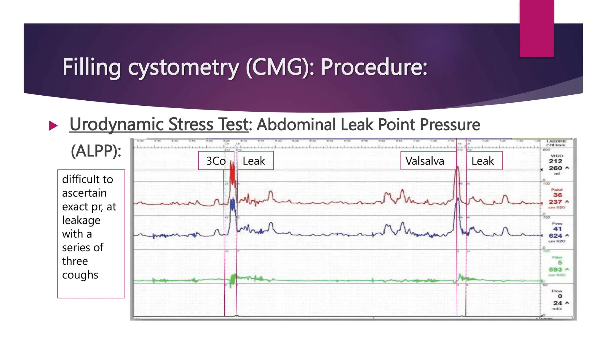 Filling cystometry (CMG): Procedure:
 Urodynamic Stress Test: Abdominal Leak Point Pressure
(ALPP):
Leak
Valsalva
3Co Leak
difficult to
ascertain
exact pr, at
leakage
with a
series of
three
coughs
 