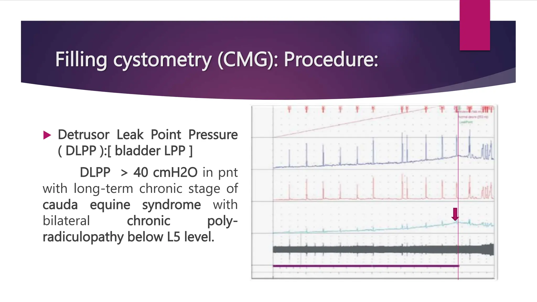 Filling cystometry (CMG): Procedure:
 Detrusor Leak Point Pressure
( DLPP ):[ bladder LPP ]
DLPP > 40 cmH2O in pnt
with long-term chronic stage of
cauda equine syndrome with
bilateral chronic poly-
radiculopathy below L5 level.
 